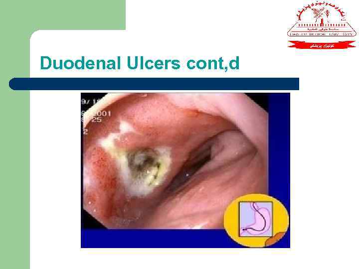 Duodenal Ulcers cont, d 