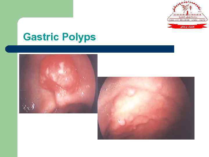 Gastric Polyps 