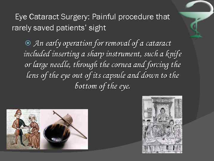 Eye Cataract Surgery: Painful procedure that rarely saved patients’ sight An early operation for