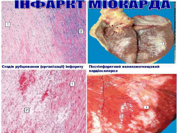 Стадія рубцювання (організації) інфаркту Постінфарктний великовогнещевий кардіосклероз 