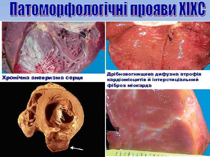 Хронічна аневризма серця Дрібновогнищева дифузна атрофія кардіоміоцитів й інтерстиціальний фіброз міокарда 