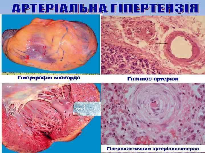Гіпертрофія міокарда Гіаліноз артеріол Гіперпластичний артеріолосклероз 