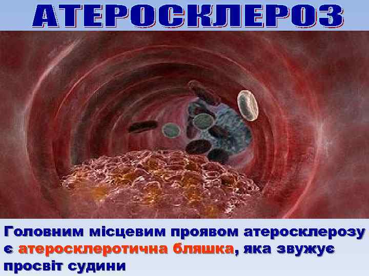 Головним місцевим проявом атеросклерозу є атеросклеротична бляшка, яка звужує просвіт судини 