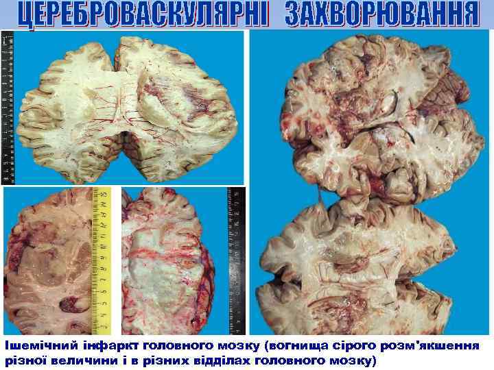 Ішемічний інфаркт головного мозку (вогнища сірого розм'якшення різної величини і в різних відділах головного