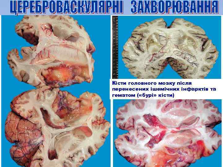 Кісти головного мозку після перенесених ішемічних інфарктів та гематом ( «бурі» кісти) 