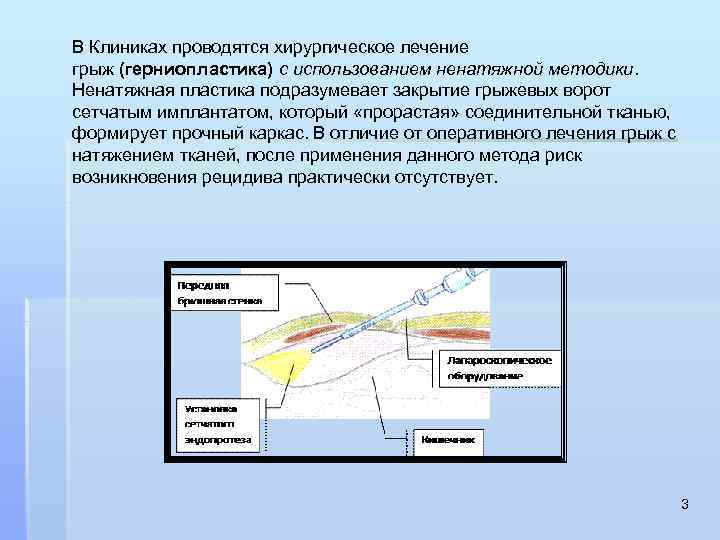 В Клиниках проводятся хирургическое лечение грыж (герниопластика) с использованием ненатяжной методики. Ненатяжная пластика подразумевает