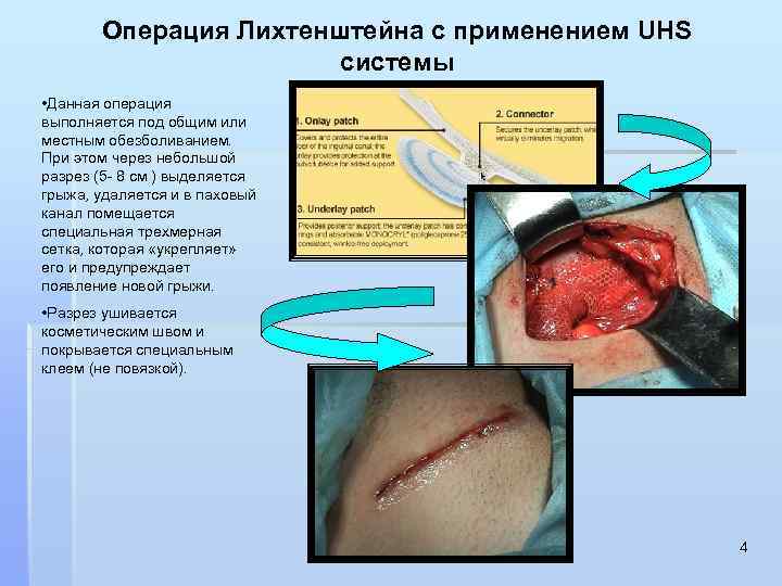 Операция Лихтенштейна с применением UHS системы • Данная операция выполняется под общим или местным