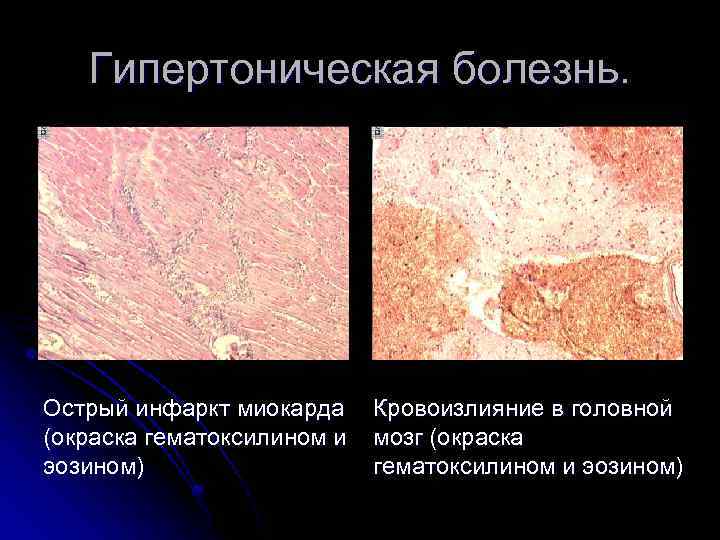 Гипертоническая болезнь. Острый инфаркт миокарда (окраска гематоксилином и эозином) Кровоизлияние в головной мозг (окраска