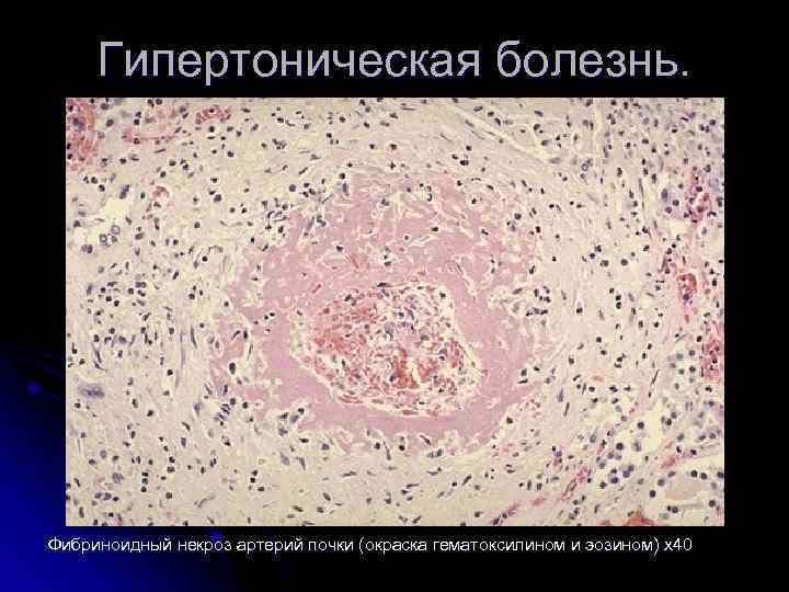 Гипертоническая болезнь. Фибриноидный некроз артерий почки (окраска гематоксилином и эозином) х40 