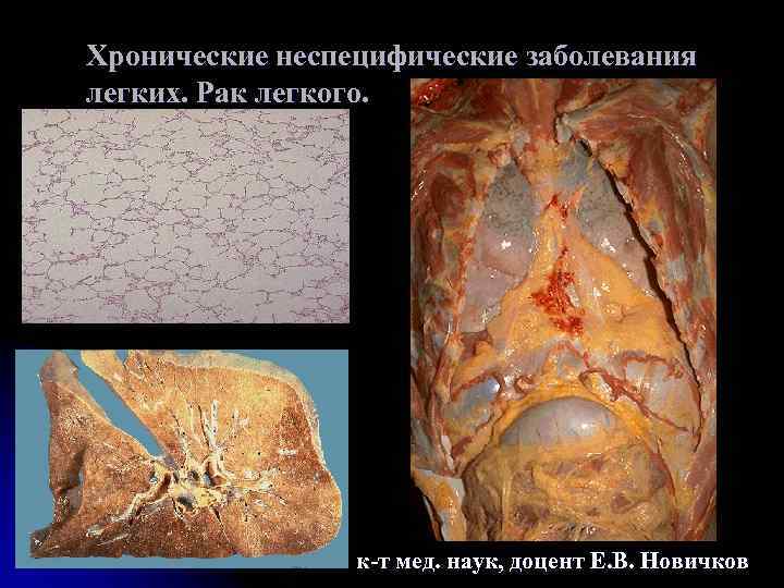 Хронические неспецифические заболевания легких. Рак легкого. к-т мед. наук, доцент Е. В. Новичков 