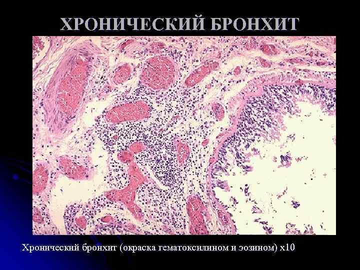 ХРОНИЧЕСКИЙ БРОНХИТ Хронический бронхит (окраска гематоксилином и эозином) х10 