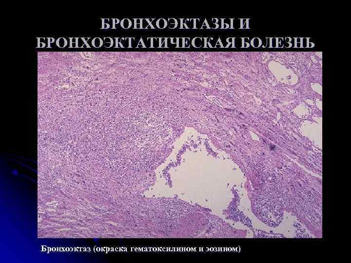БРОНХОЭКТАЗЫ И БРОНХОЭКТАТИЧЕСКАЯ БОЛЕЗНЬ Бронхоэктаз (окраска гематоксилином и эозином) 