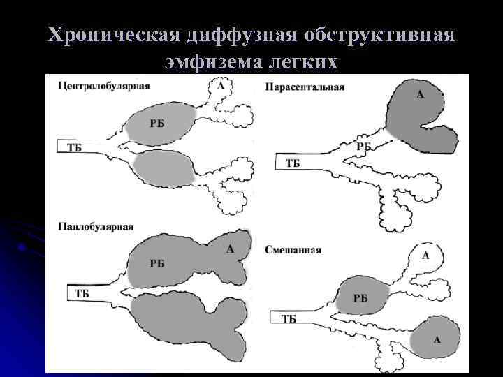 Хроническая диффузная обструктивная эмфизема легких 