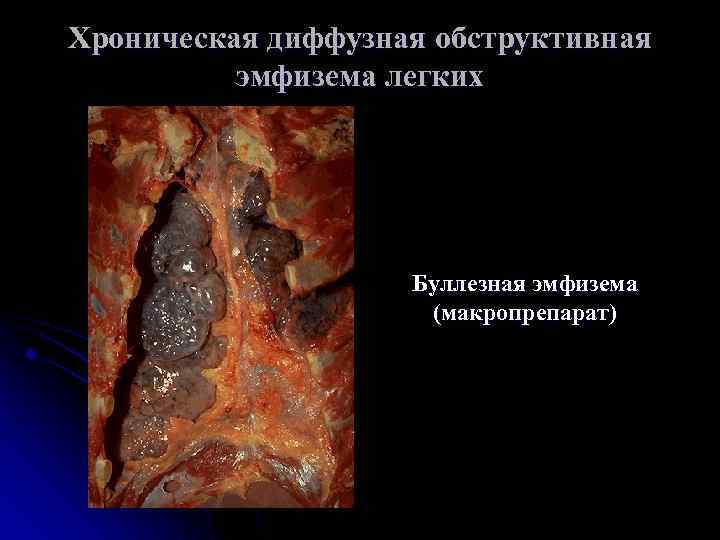 Хроническая диффузная обструктивная эмфизема легких Буллезная эмфизема (макропрепарат) 