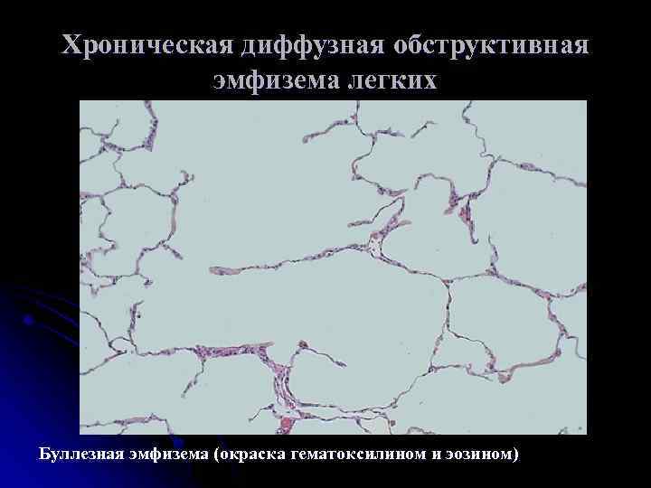 Хроническая диффузная обструктивная эмфизема легких Буллезная эмфизема (окраска гематоксилином и эозином) 