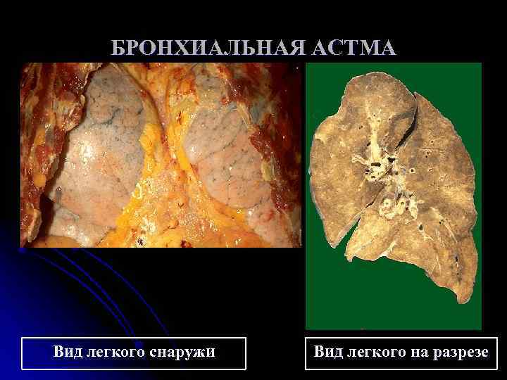 БРОНХИАЛЬНАЯ АСТМА Вид легкого снаружи Вид легкого на разрезе 