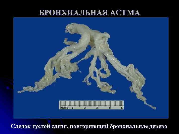 БРОНХИАЛЬНАЯ АСТМА Слепок густой слизи, повторяющий бронхиальнле дерево 