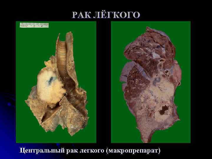 РАК ЛЁГКОГО Центральный рак легкого (макропрепарат) 