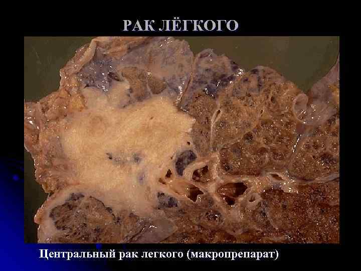 РАК ЛЁГКОГО Центральный рак легкого (макропрепарат) 