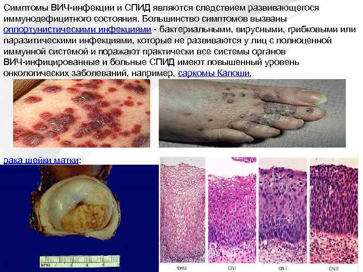 Симптомы ВИЧ-инфекции и СПИД являются следствием развивающегося иммунодефицитного состояния. Большинство симптомов вызваны оппортунистическими инфекциями