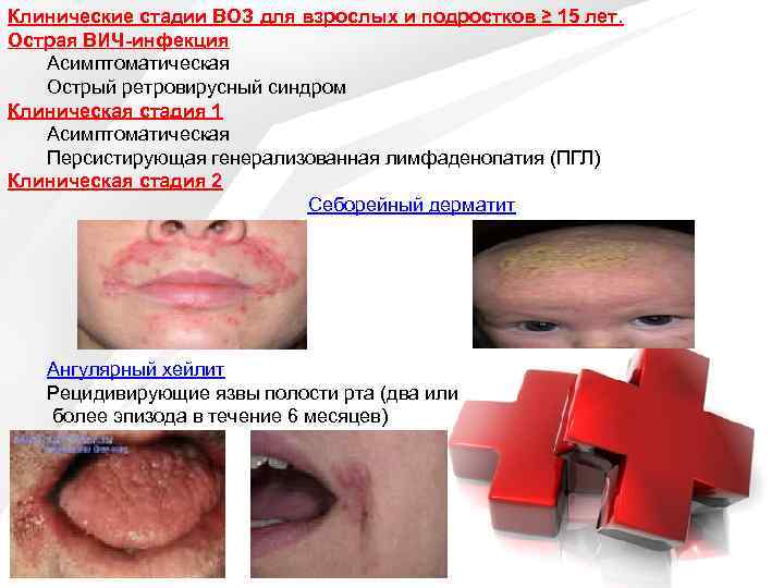 Клинические стадии ВОЗ для взрослых и подростков ≥ 15 лет. Острая ВИЧ-инфекция Асимптоматическая Острый