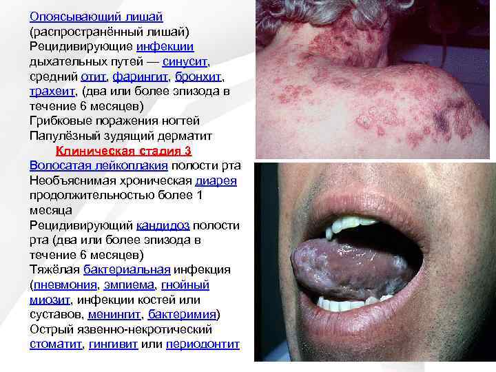 Опоясывающий лишай (распространённый лишай) Рецидивирующие инфекции дыхательных путей — синусит, средний отит, фарингит, бронхит,