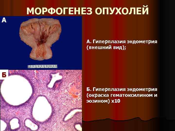 А МОРФОГЕНЕЗ ОПУХОЛЕЙ А. Гиперплазия эндометрия (внешний вид); Б Б. Гиперплазия эндометрия (окраска гематоксилином