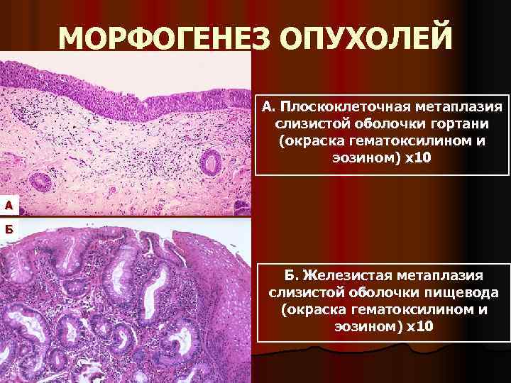 МОРФОГЕНЕЗ ОПУХОЛЕЙ А. Плоскоклеточная метаплазия слизистой оболочки гортани (окраска гематоксилином и эозином) х10 А