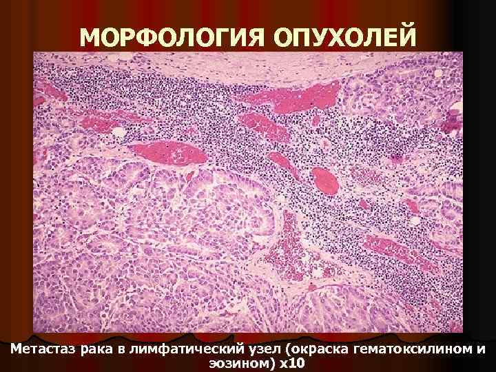 МОРФОЛОГИЯ ОПУХОЛЕЙ Метастаз рака в лимфатический узел (окраска гематоксилином и эозином) х10 