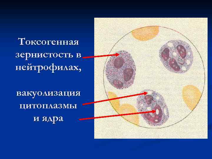 Токсогенная зернистость в нейтрофилах, вакуолизация цитоплазмы и ядра 