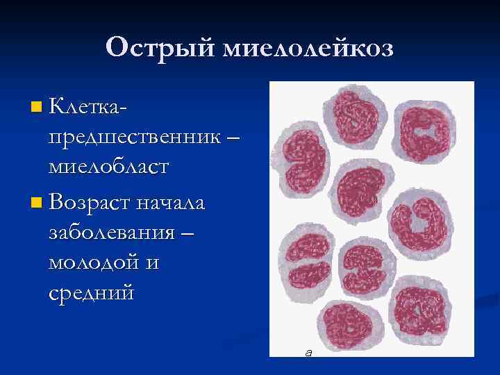 Острый миелолейкоз картина крови