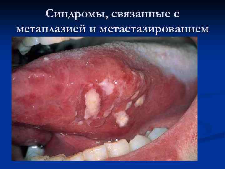 Синдромы, связанные с метаплазией и метастазированием n Увеличение лимфоузлов, печени, селезенки n Кожный синдром