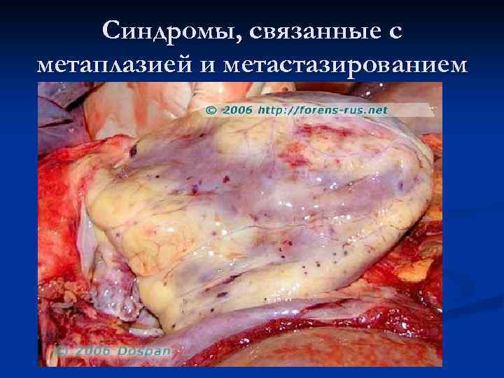 Синдромы, связанные с метаплазией и метастазированием n Костно-суставной синдром n Нейролейкоз n Лейкозный пневмонит