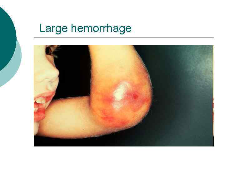 Large hemorrhage 