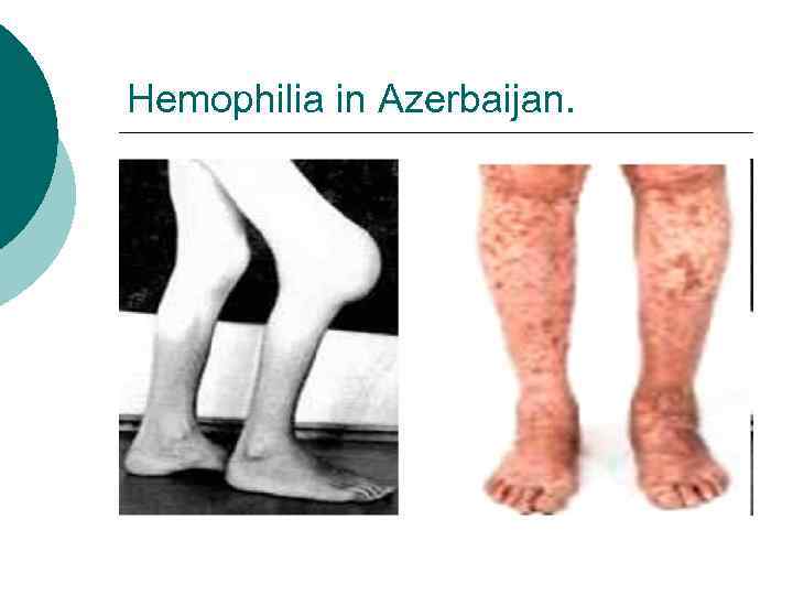 Hemophilia in Azerbaijan. 