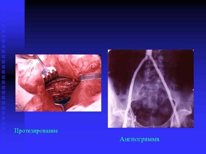 Протезирование Ангиограмма 