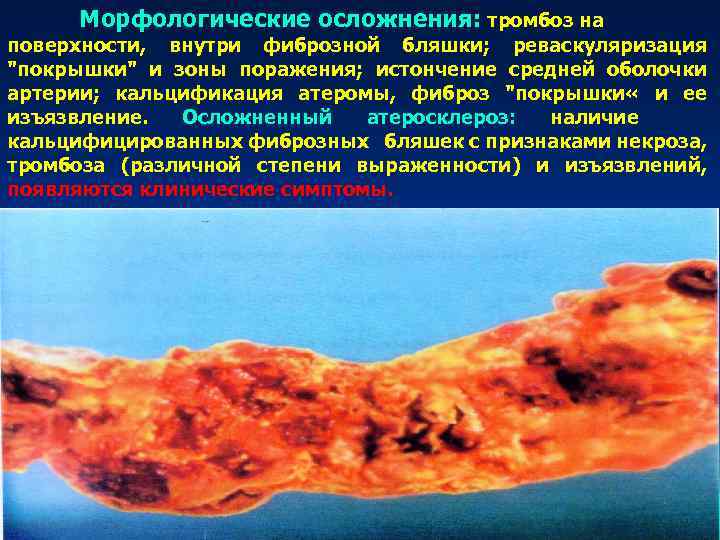 Морфологические осложнения: тромбоз на поверхности, внутри фиброзной бляшки; реваскуляризация 