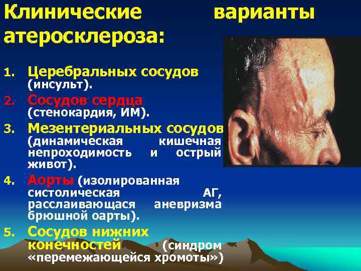 Клинические атеросклероза: варианты 1. Церебральных сосудов 2. Сосудов сердца 3. Мезентериальных сосудов 4. 5.