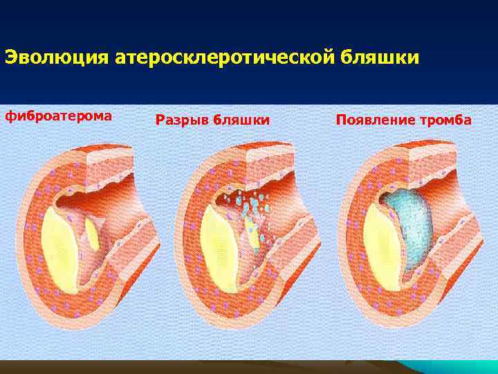 Эволюция атеросклеротической бляшки фиброатерома Разрыв бляшки Появление тромба 