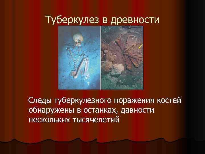 Туберкулез в древности Следы туберкулезного поражения костей обнаружены в останках, давности нескольких тысячелетий 