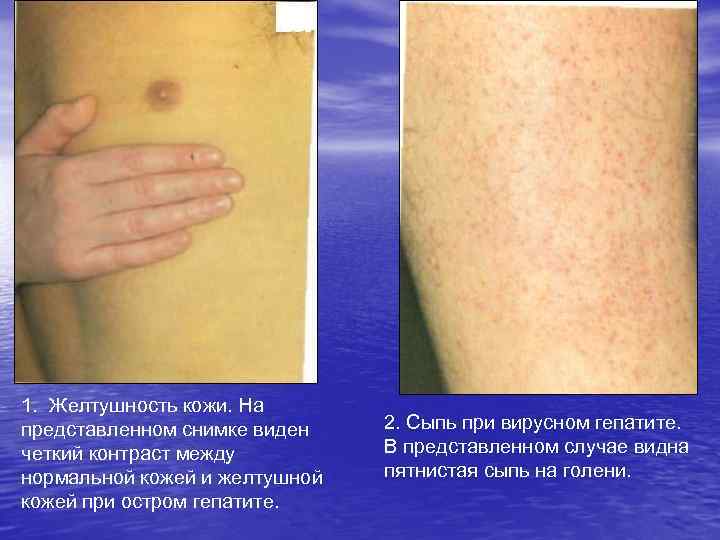 1. Желтушность кожи. На представленном снимке виден четкий контраст между нормальной кожей и желтушной