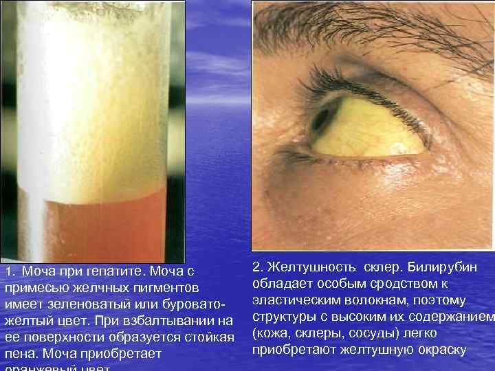 1. Моча при гепатите. Моча с примесью желчных пигментов имеет зеленоватый или буроватожелтый цвет.