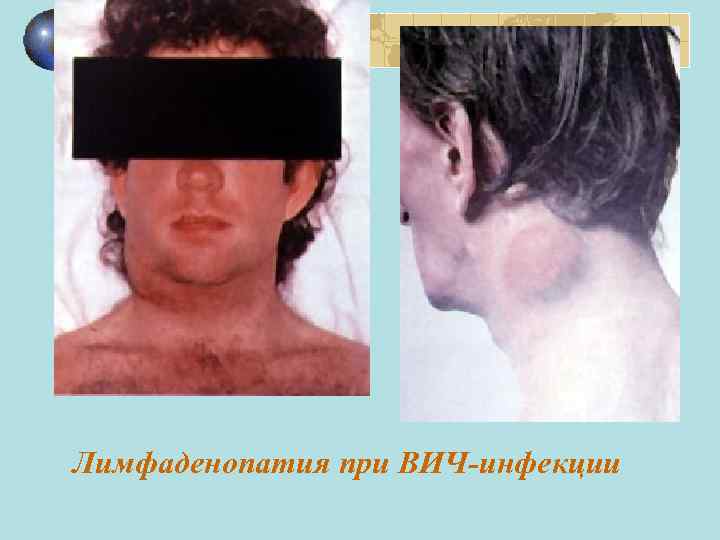 Лимфаденопатия при ВИЧ-инфекции 
