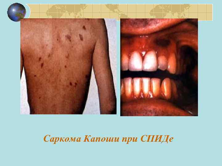 Саркома Капоши при СПИДе 