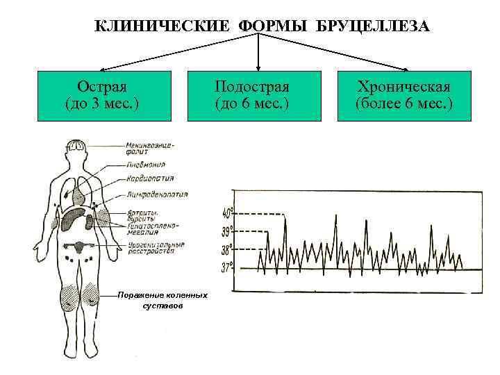 КЛИНИЧЕСКИЕ ФОРМЫ БРУЦЕЛЛЕЗА Острая (до 3 мес. ) Поражение коленных суставов Подострая (до 6
