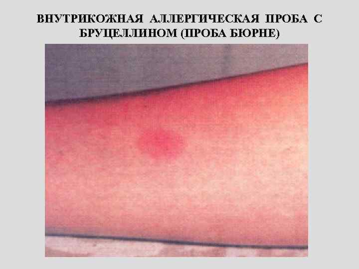 ВНУТРИКОЖНАЯ АЛЛЕРГИЧЕСКАЯ ПРОБА С БРУЦЕЛЛИНОМ (ПРОБА БЮРНЕ) 