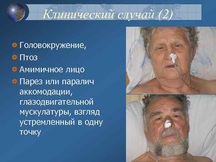 Клинический случай (2) Головокружение, Птоз Амимичное лицо Парез или паралич аккомодации, глазодвигательной мускулатуры, взгляд