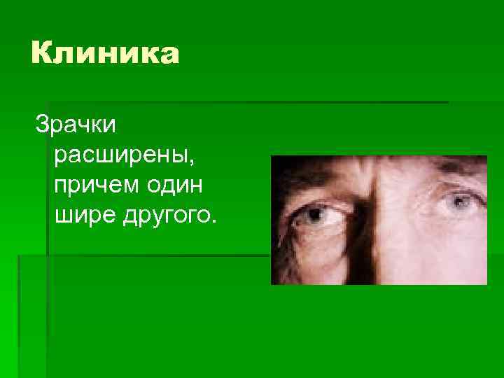 Клиника Зрачки расширены, причем один шире другого. 