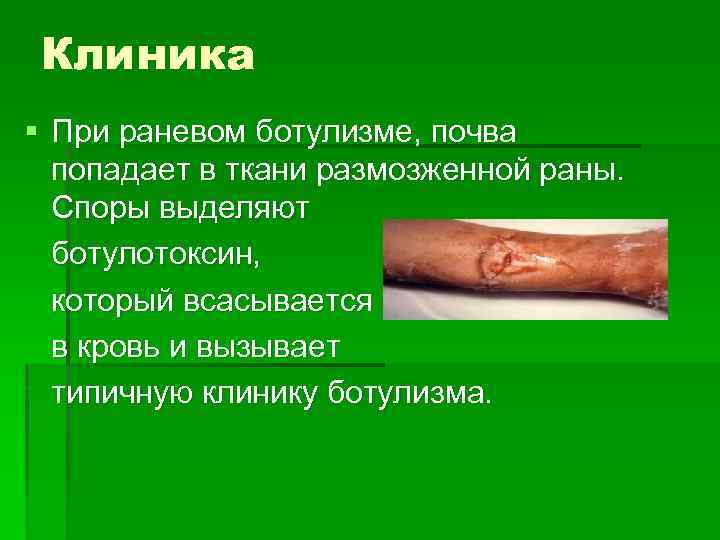 Клиника § При раневом ботулизме, почва попадает в ткани размозженной раны. Споры выделяют ботулотоксин,