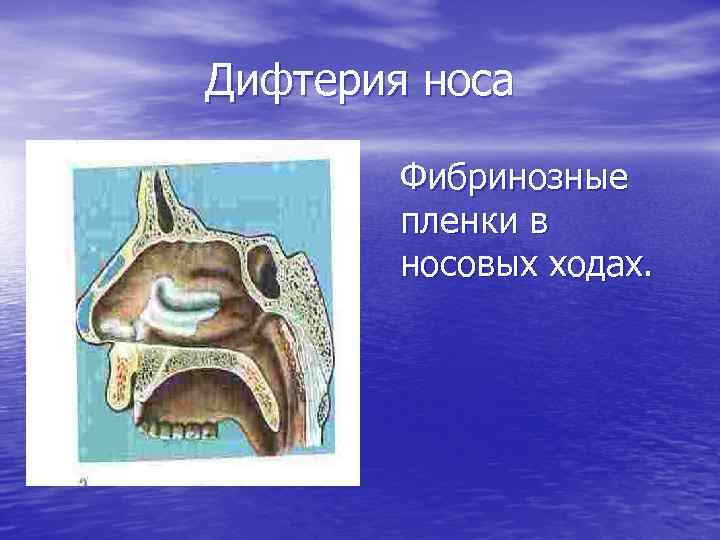 Дифтерия носа Фибринозные пленки в носовых ходах. 